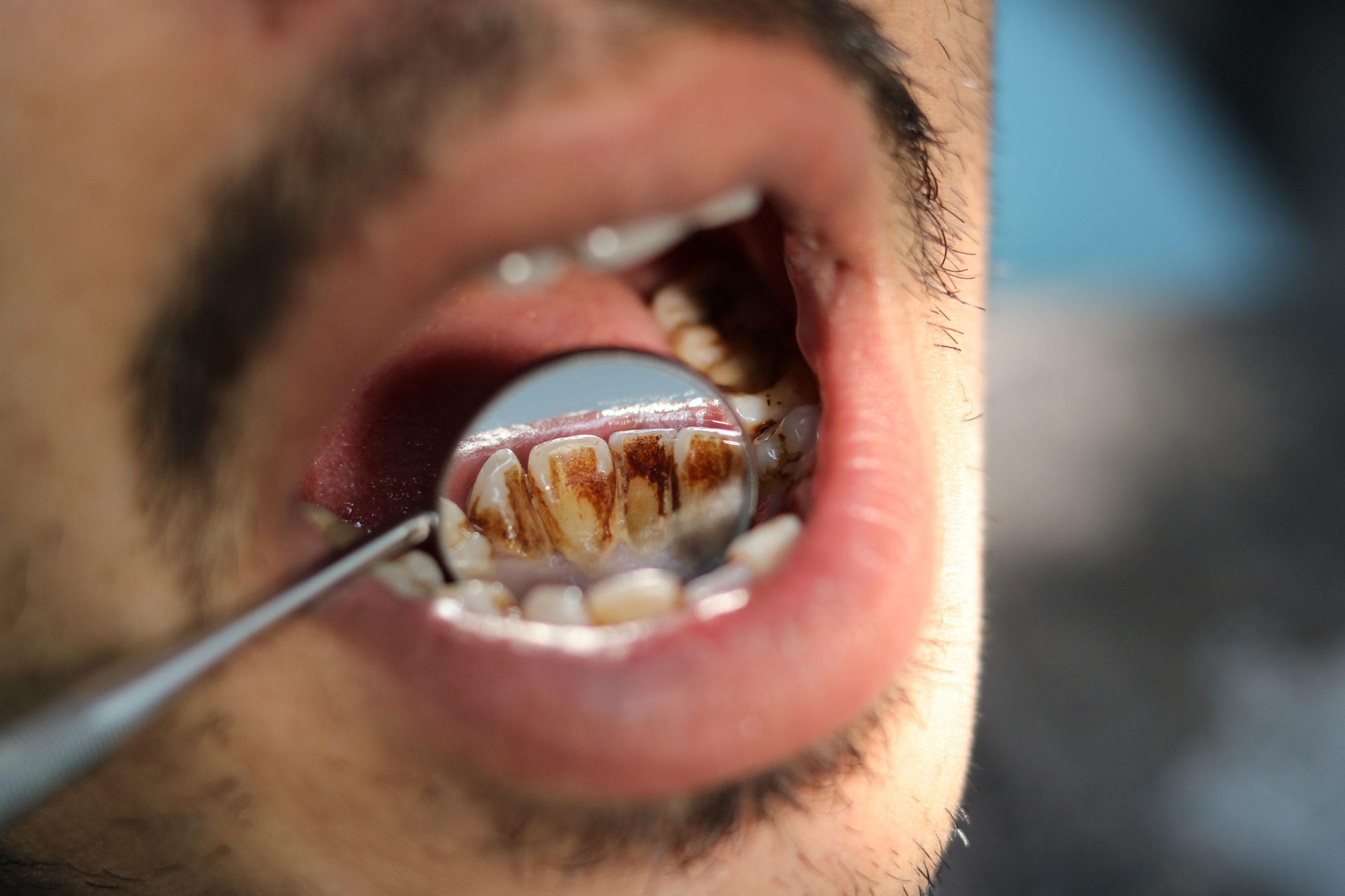 Dişlerin Üzerindeki Siyah Lekeler Nasıl Tedavi Edilir?