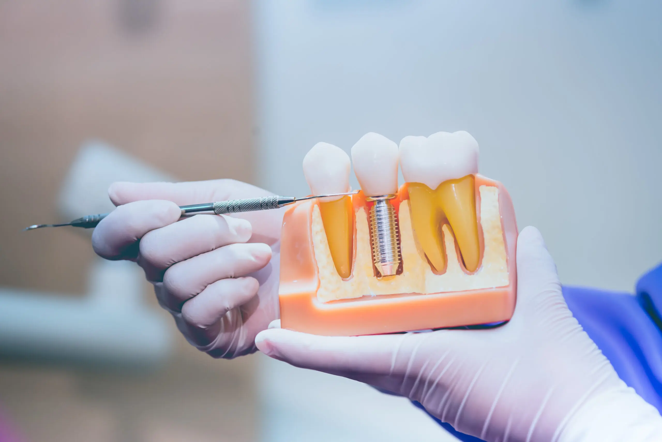 İzmir diş implant tedavisi DentOmega