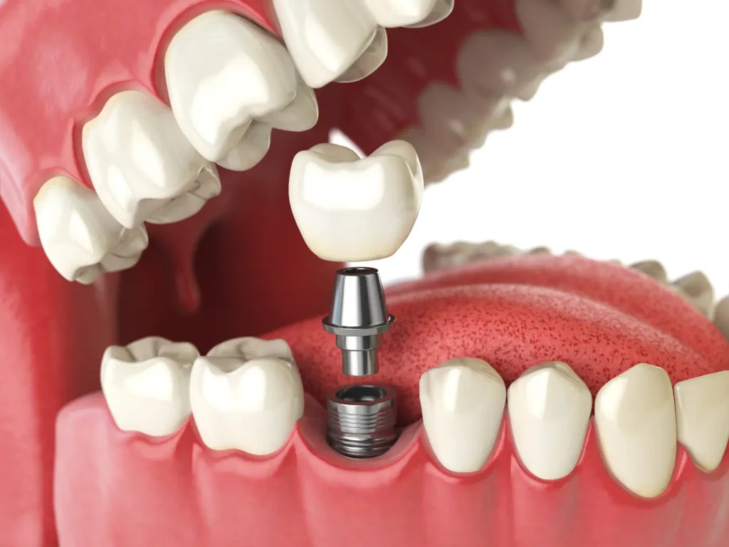 implant fiyatları