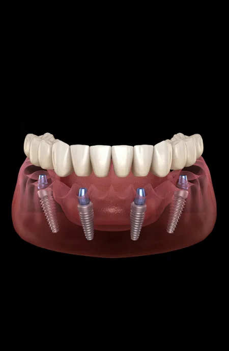 All-on-Four implant tedavisinde dört implantla tam çene protezi planlaması