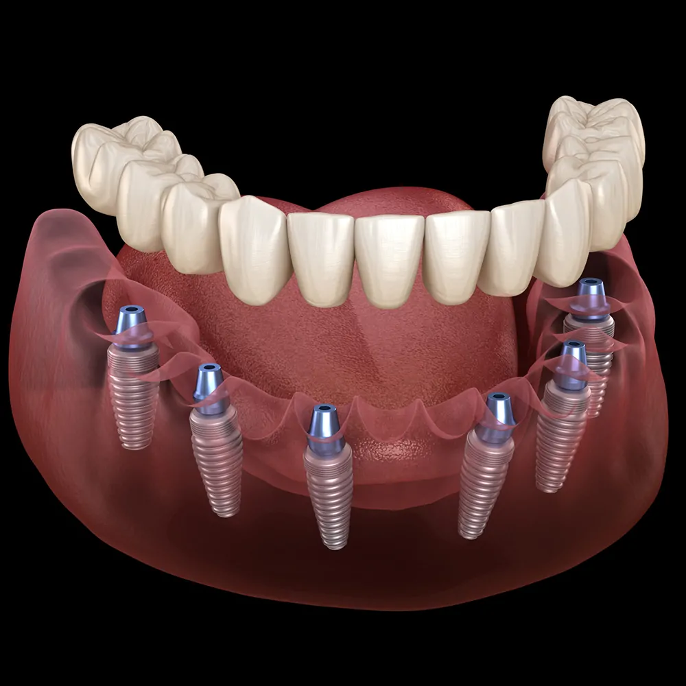 İzmir All-on-Six implant tedavisi