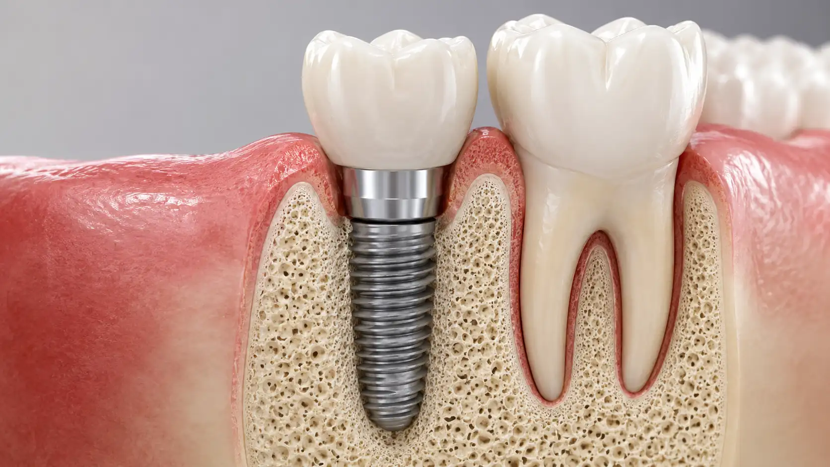 Aydın implant tedavisi ve diş implantı uygulaması