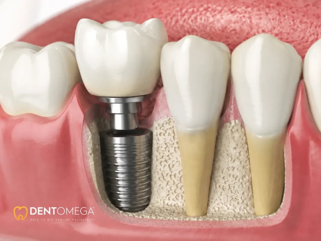 izmir'de implant tedavisi