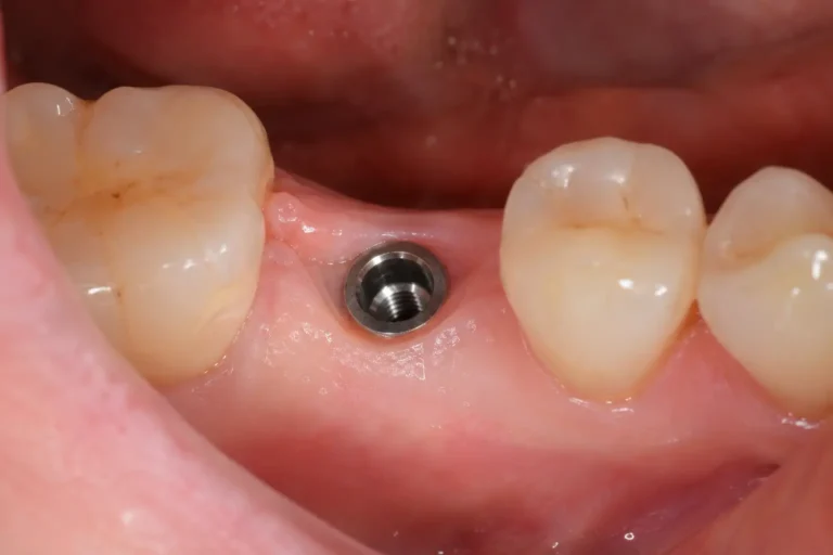 izmirde-implant-süreci-nasıl-ilerler
