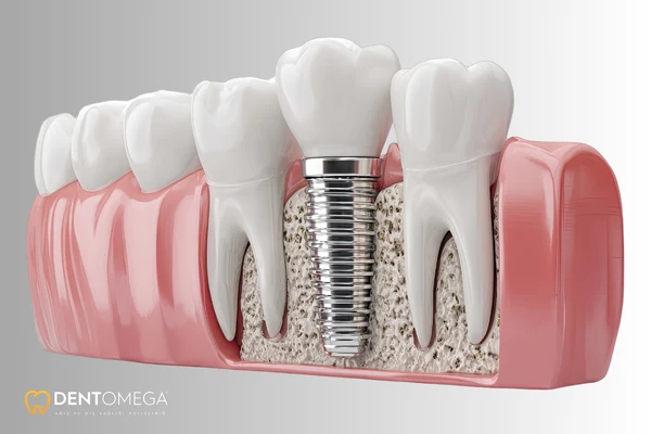 implant