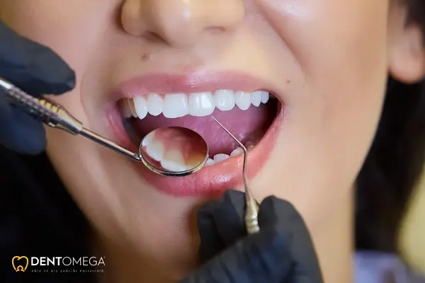 vidasız implant